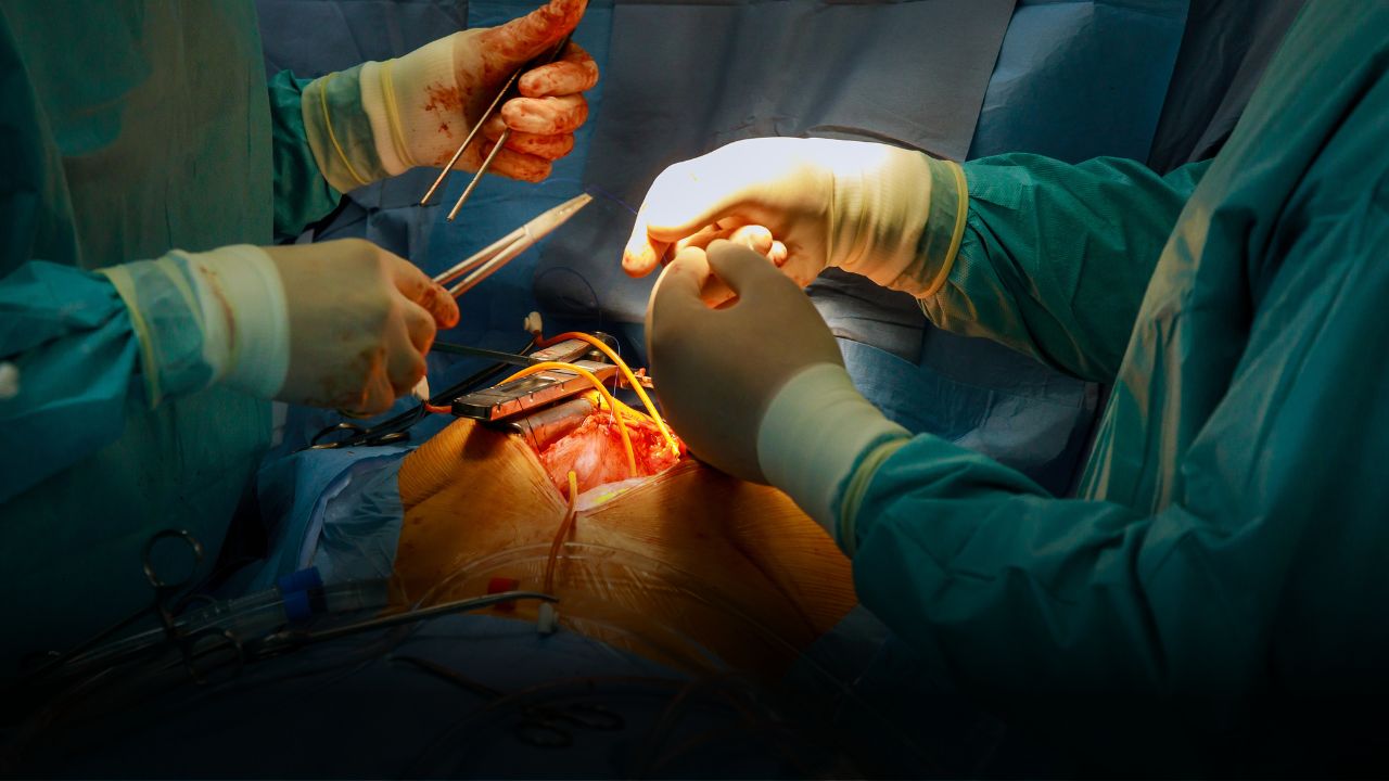 heart-bypass-surgery